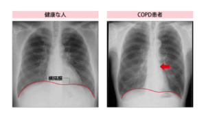 COPDの胸部レントゲン